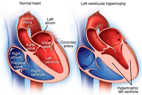 mildly increased left ventricular wall